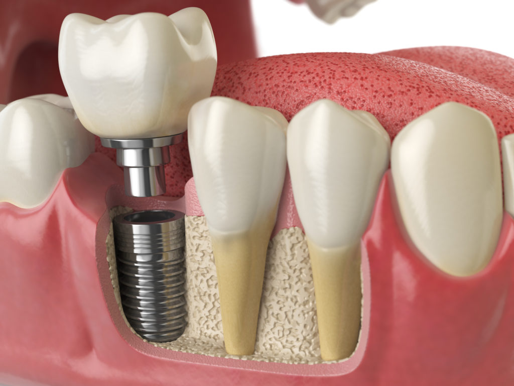 Why consider dental implants
